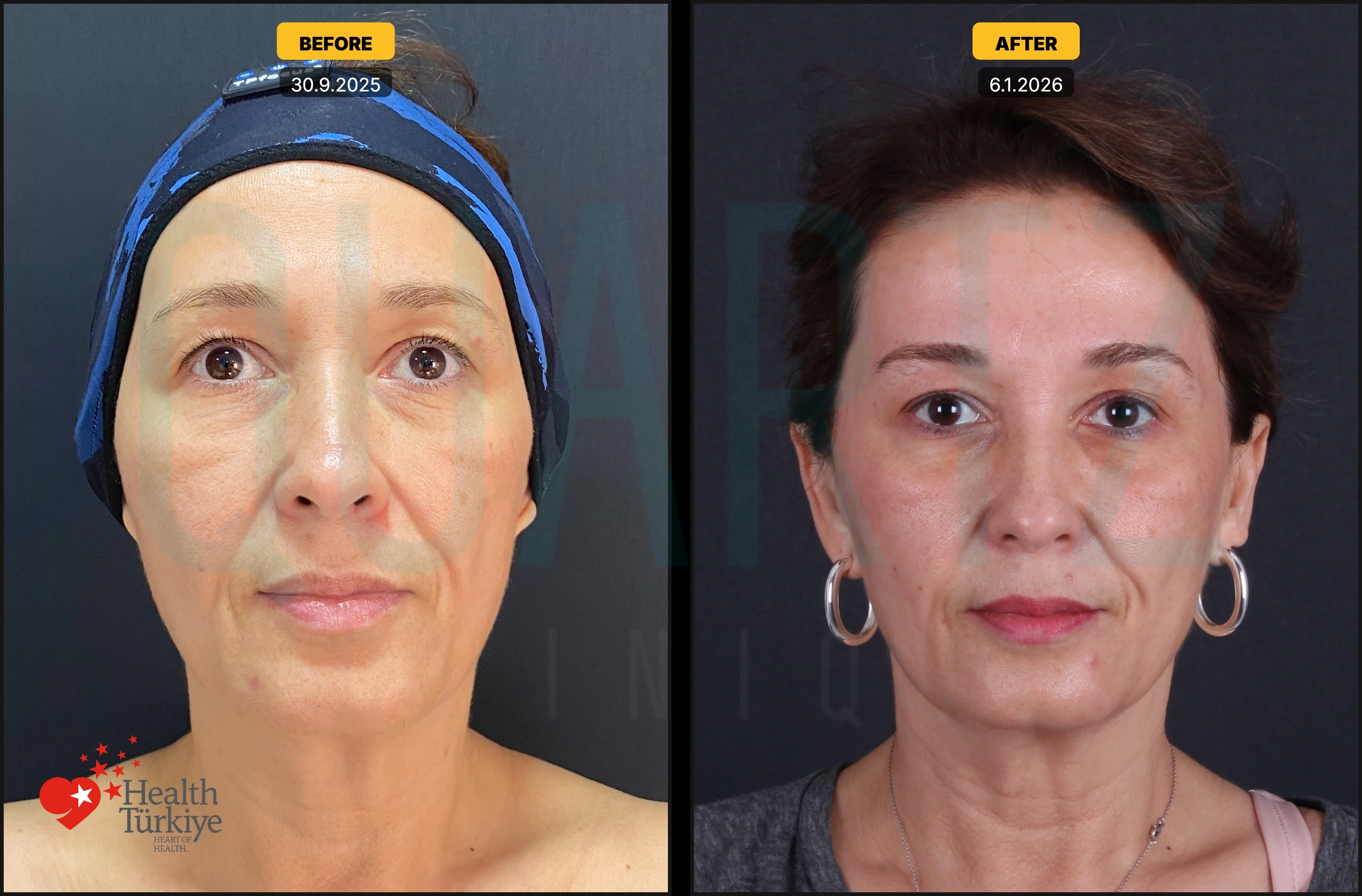 Before & After: Facial Fat Transfer Result 1