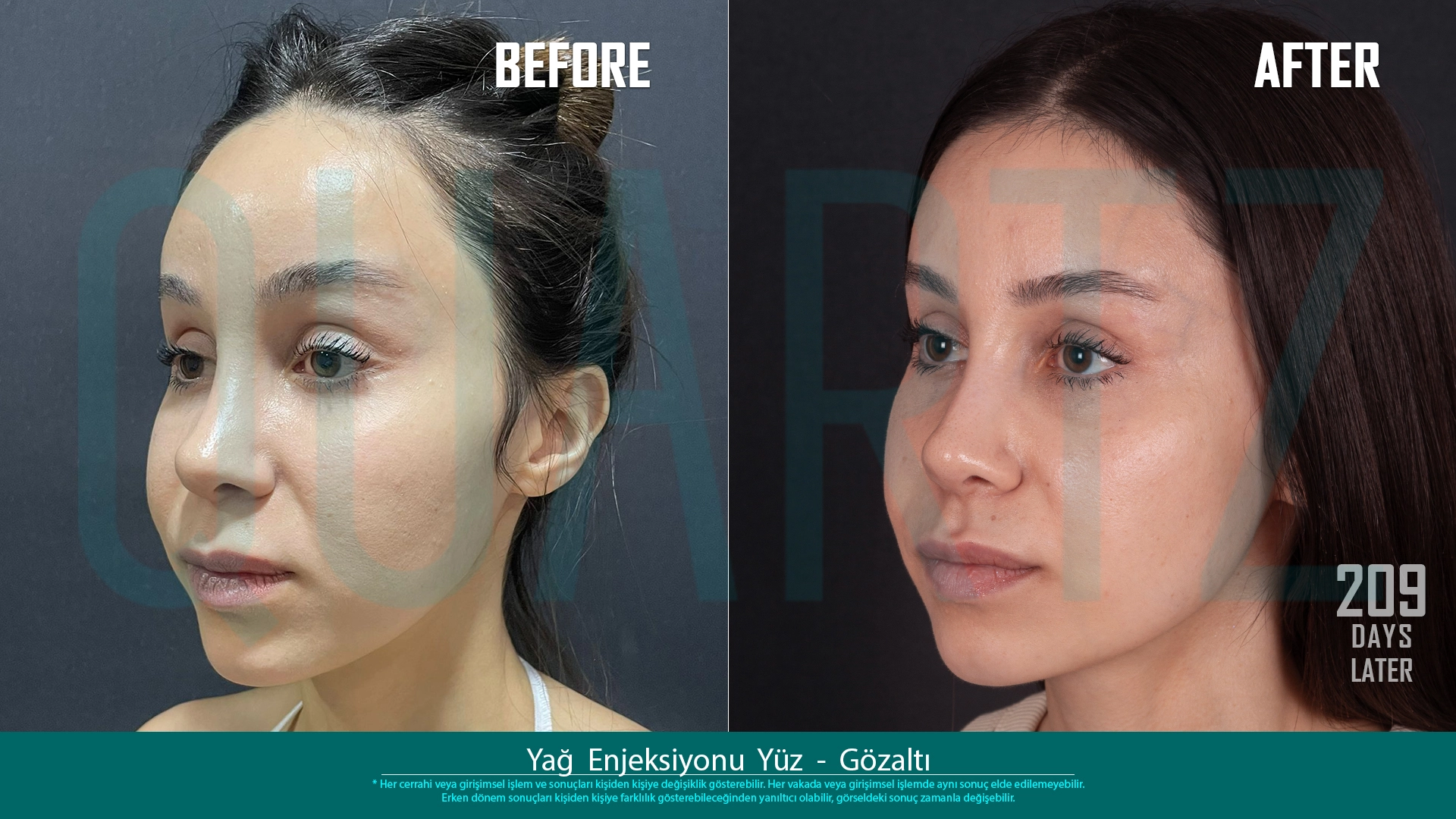 Before & After: Facial Fat Transfer Result 10