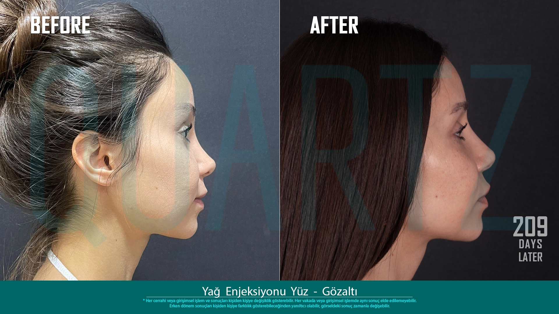 Before & After: Facial Fat Transfer Result 11