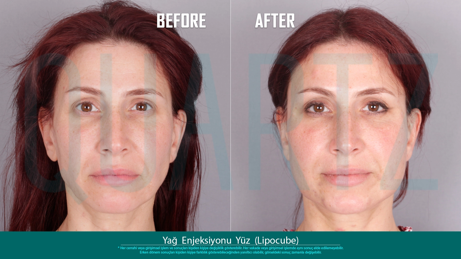Before & After: Facial Fat Transfer Result 12