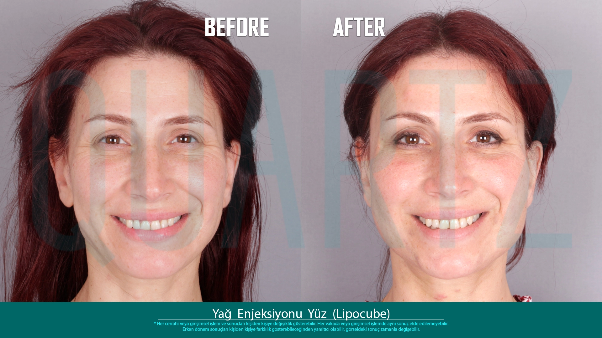 Before & After: Facial Fat Transfer Result 13