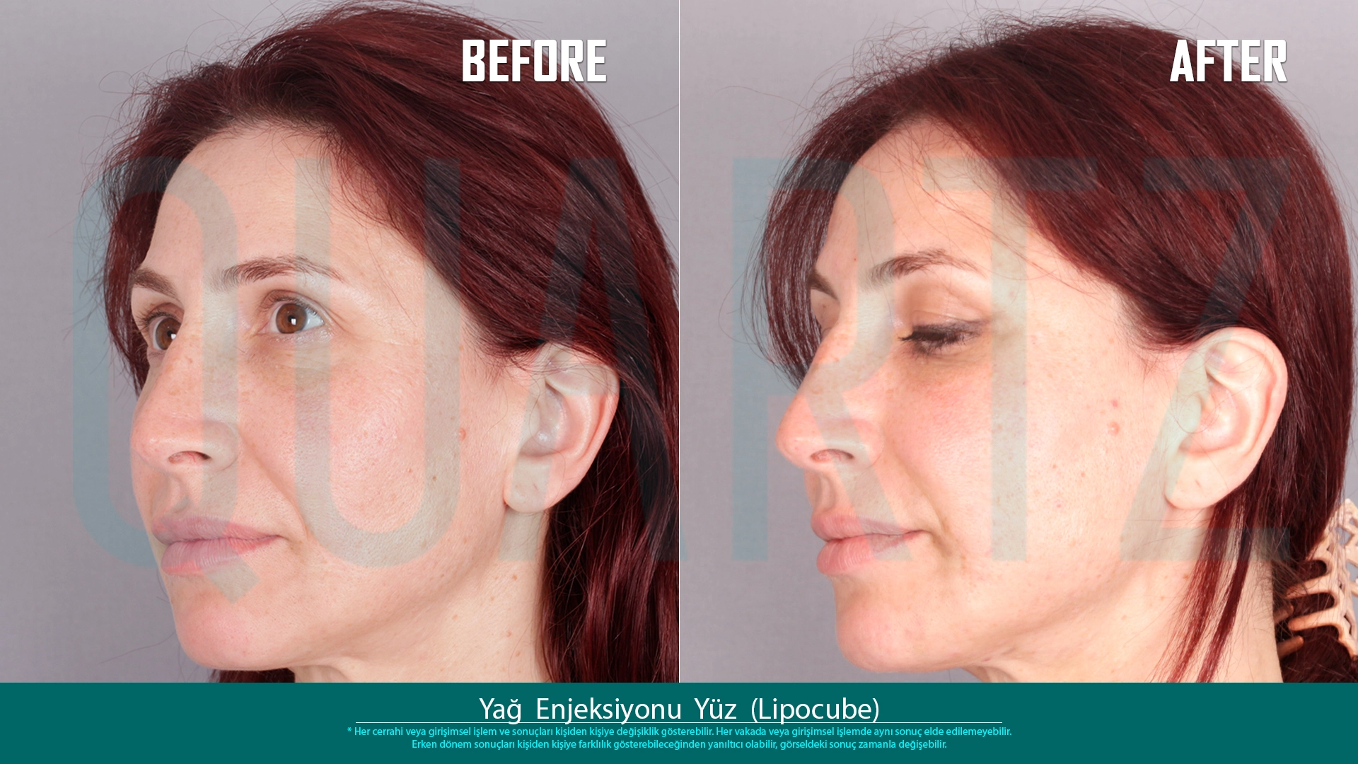 Before & After: Facial Fat Transfer Result 14