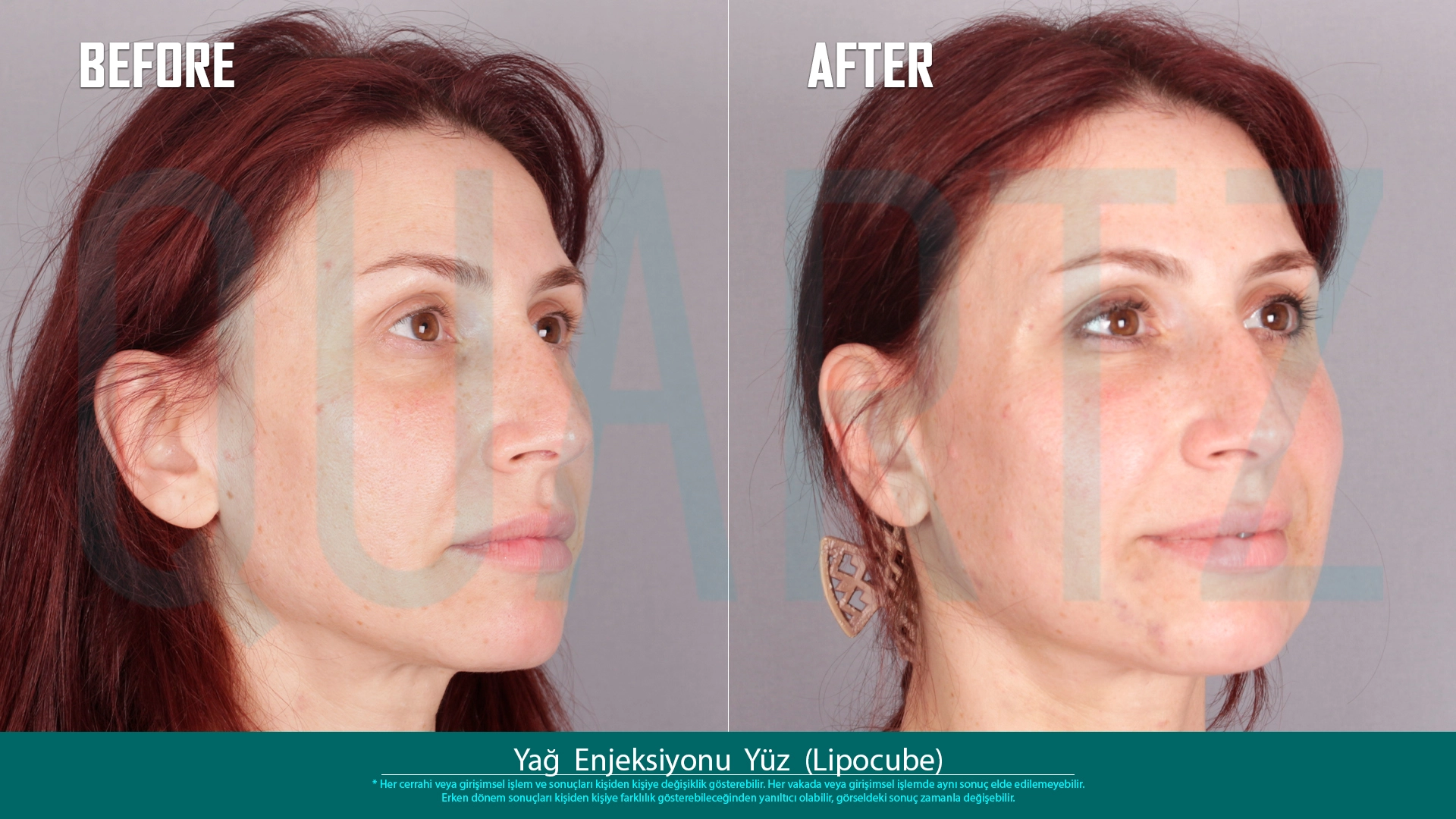 Before & After: Facial Fat Transfer Result 15
