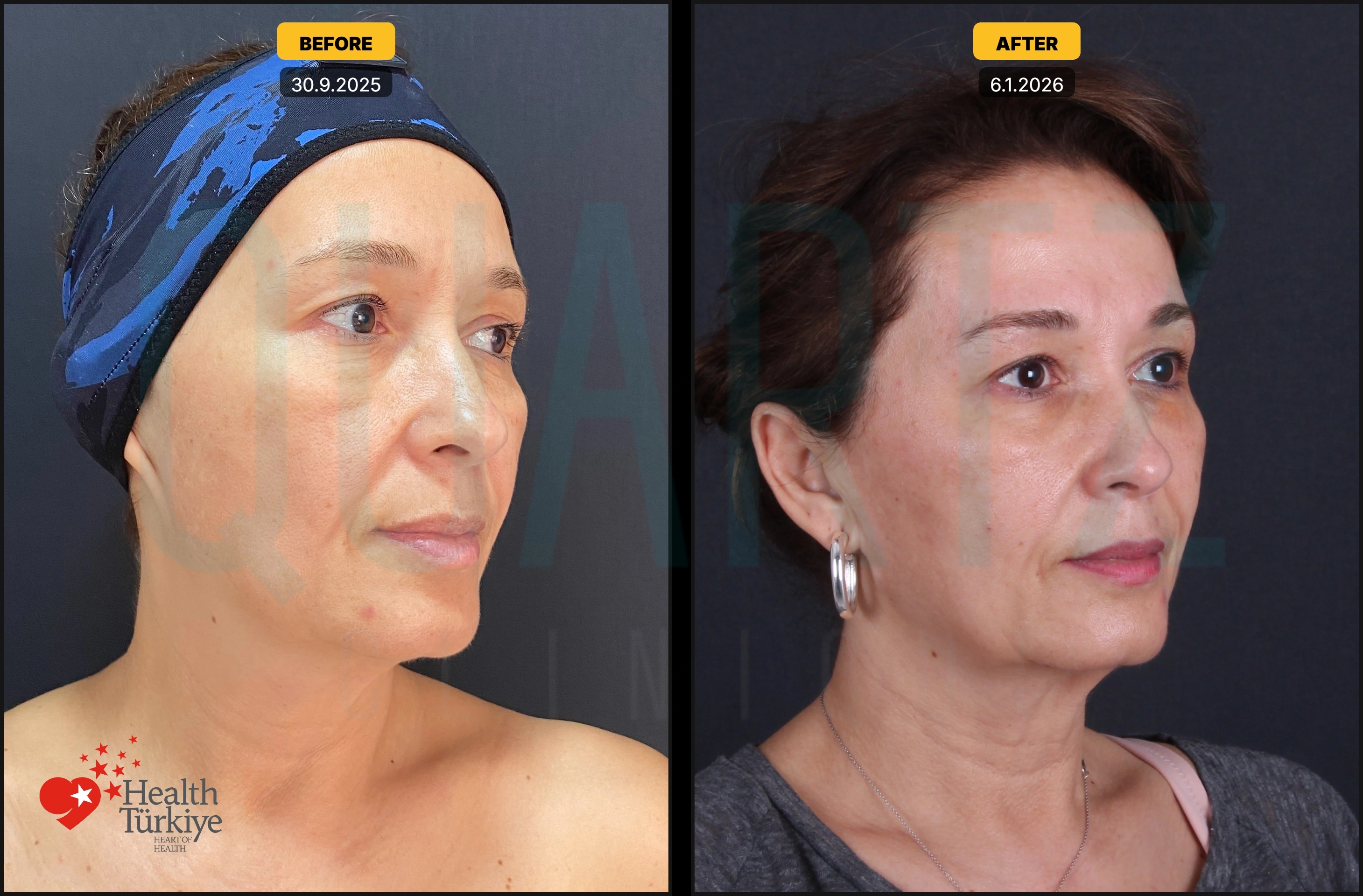 Before & After: Facial Fat Transfer Result 2