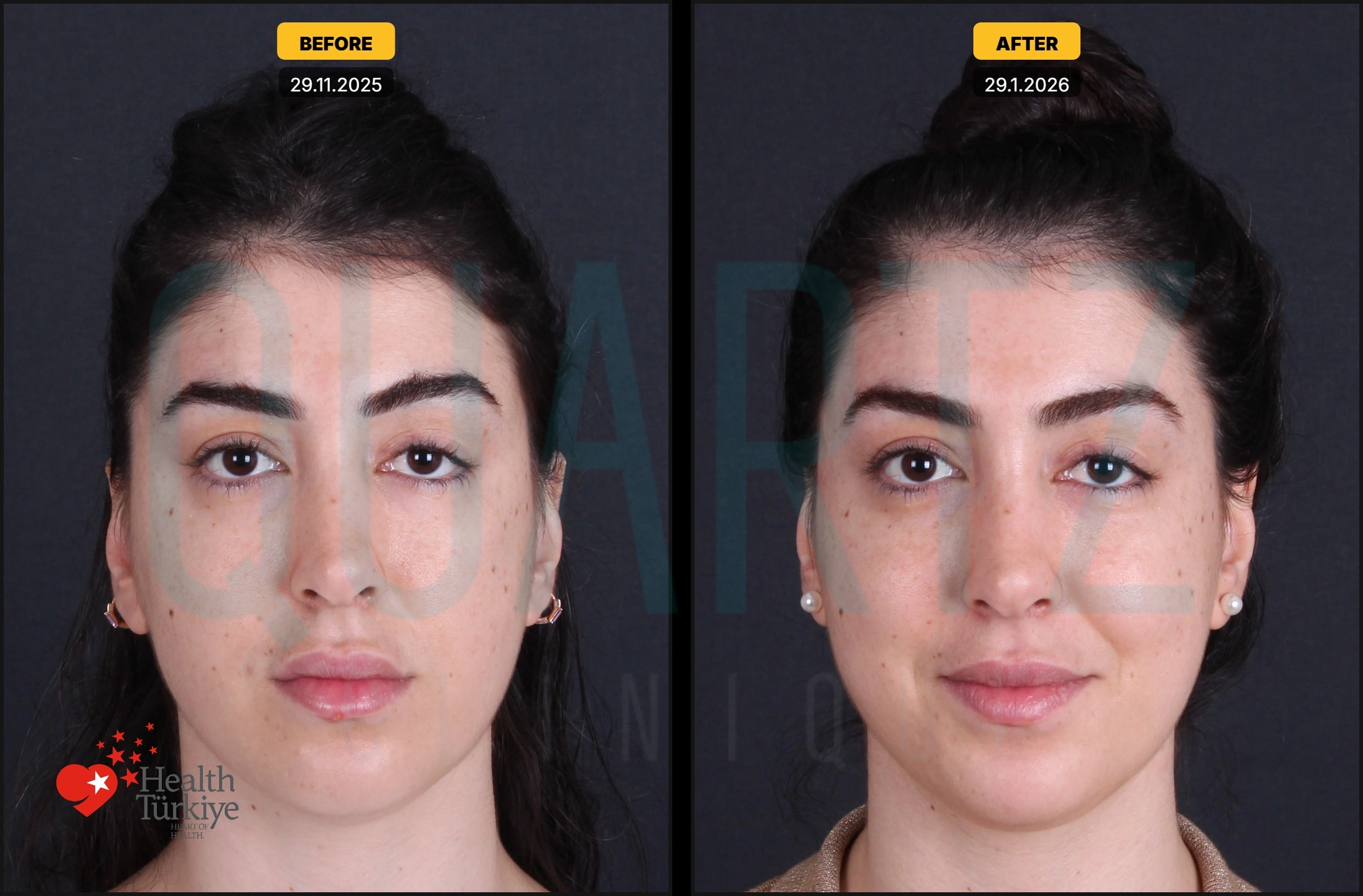 Before & After: Facial Fat Transfer Result 3