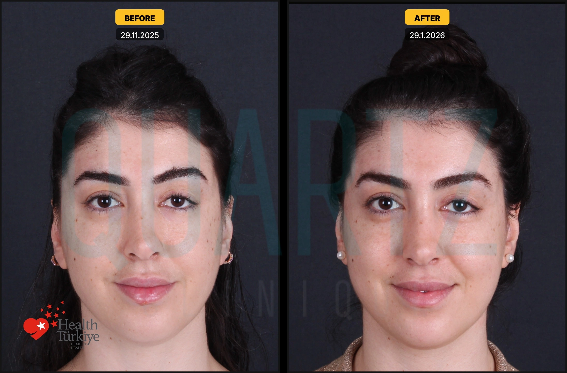 Before & After: Facial Fat Transfer Result 4