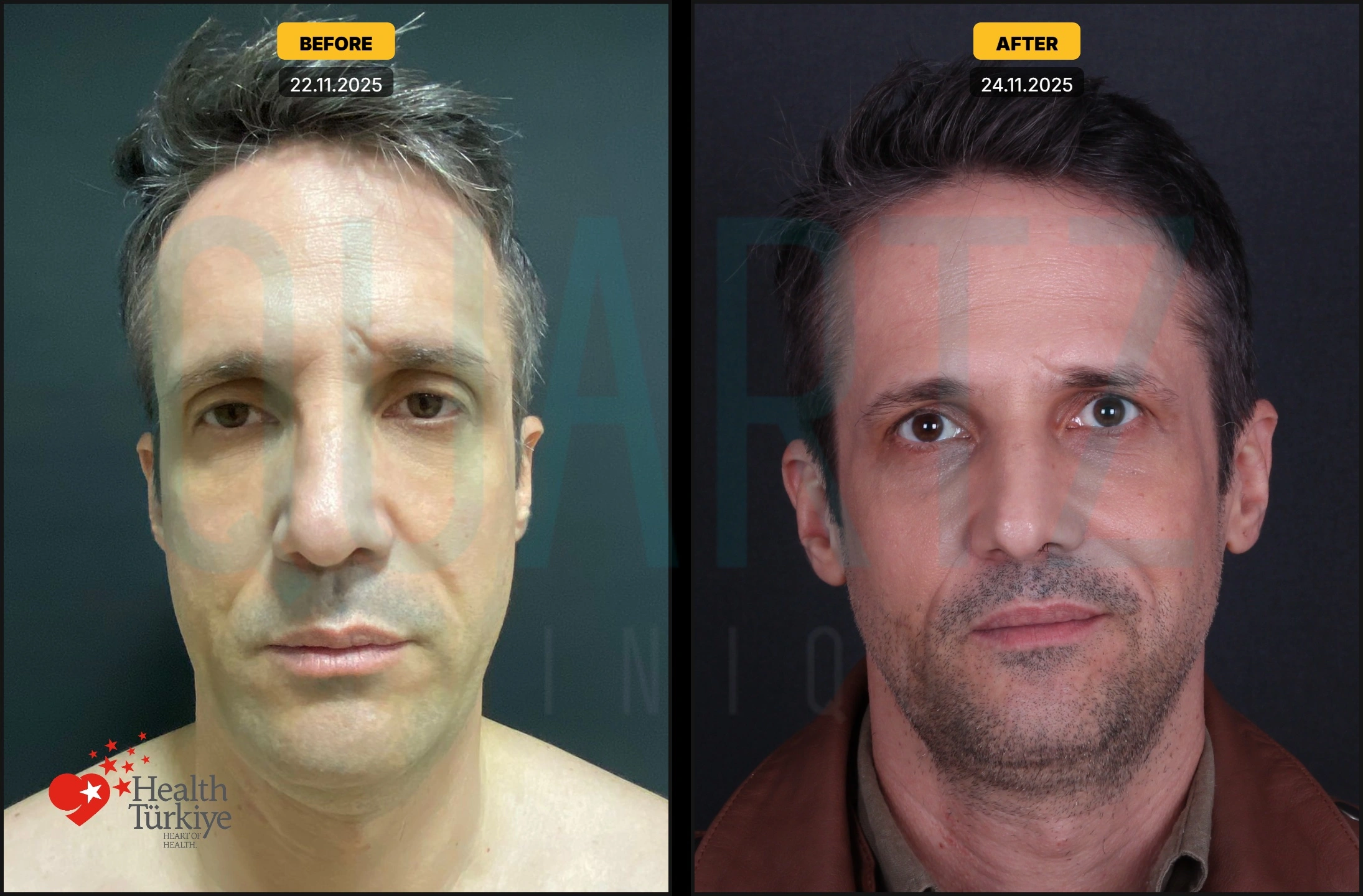 Before & After: Facial Fat Transfer Result 5