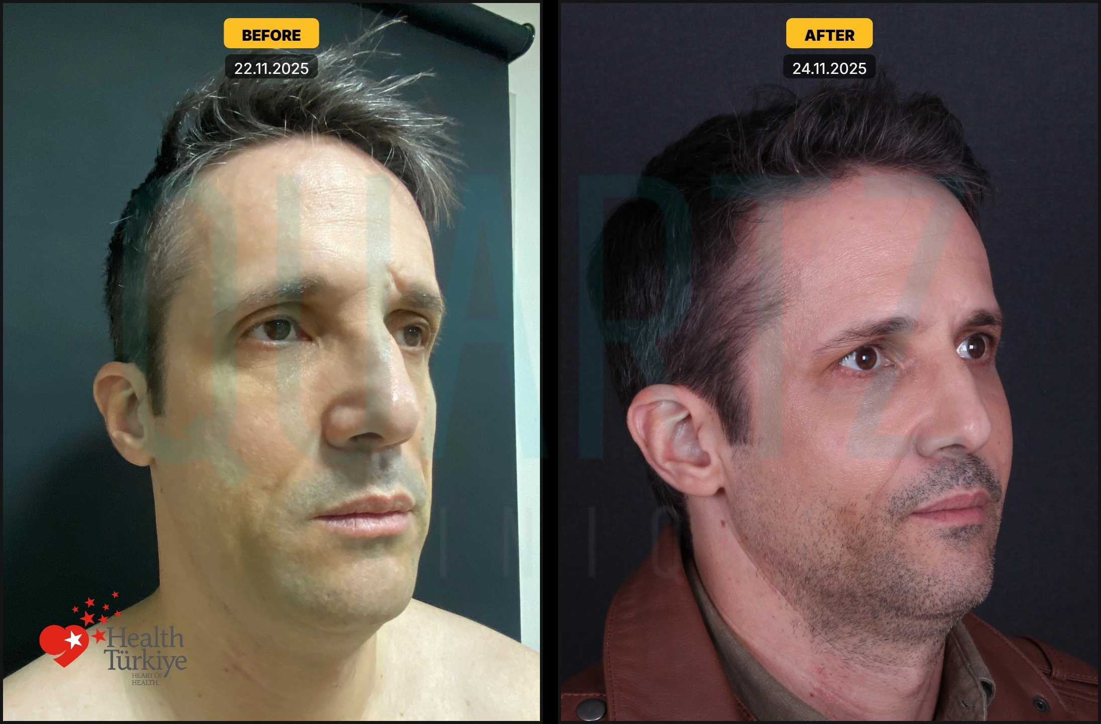 Before & After: Facial Fat Transfer Result 6