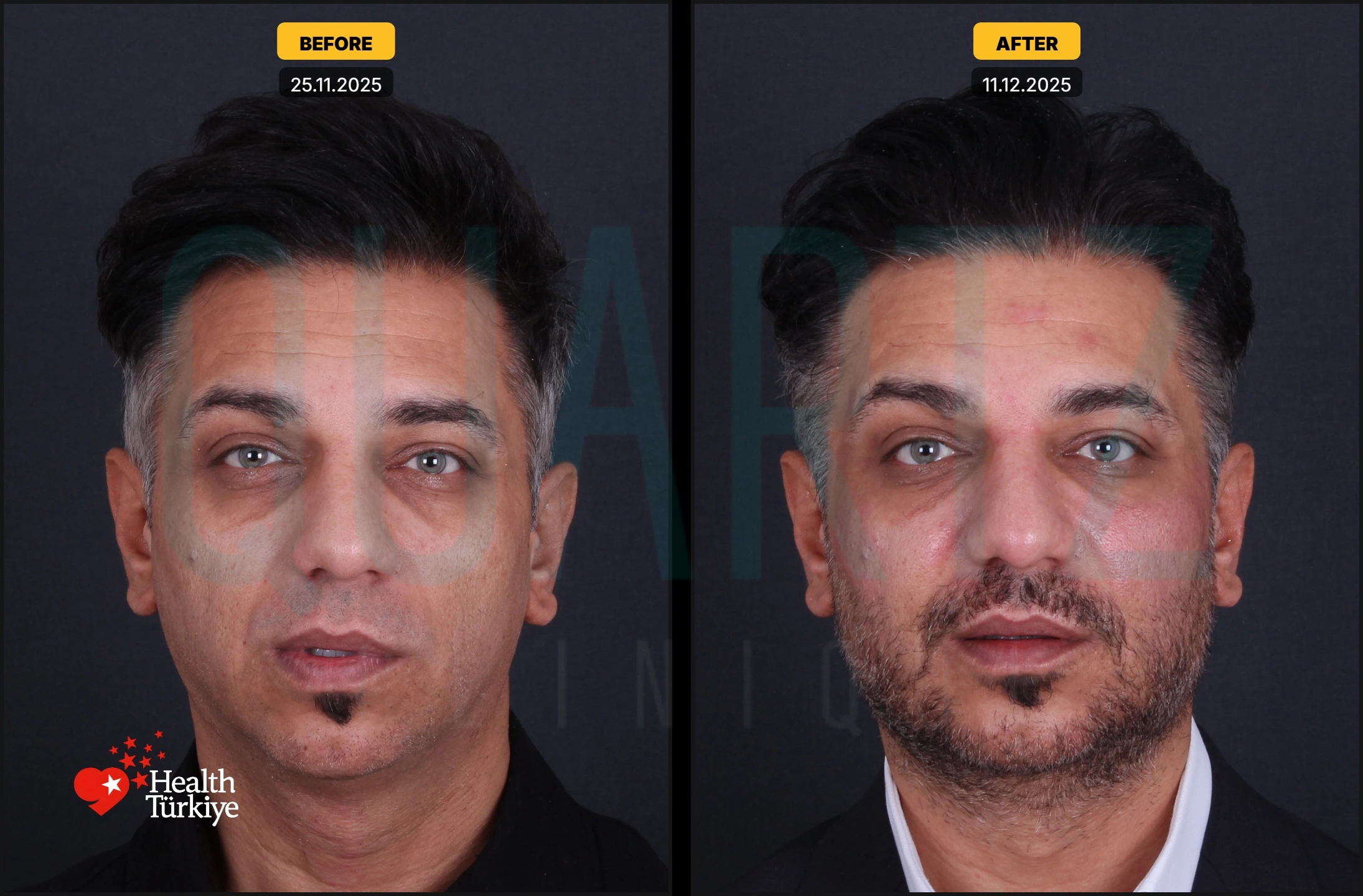 Before & After: Facial Fat Transfer Result 7
