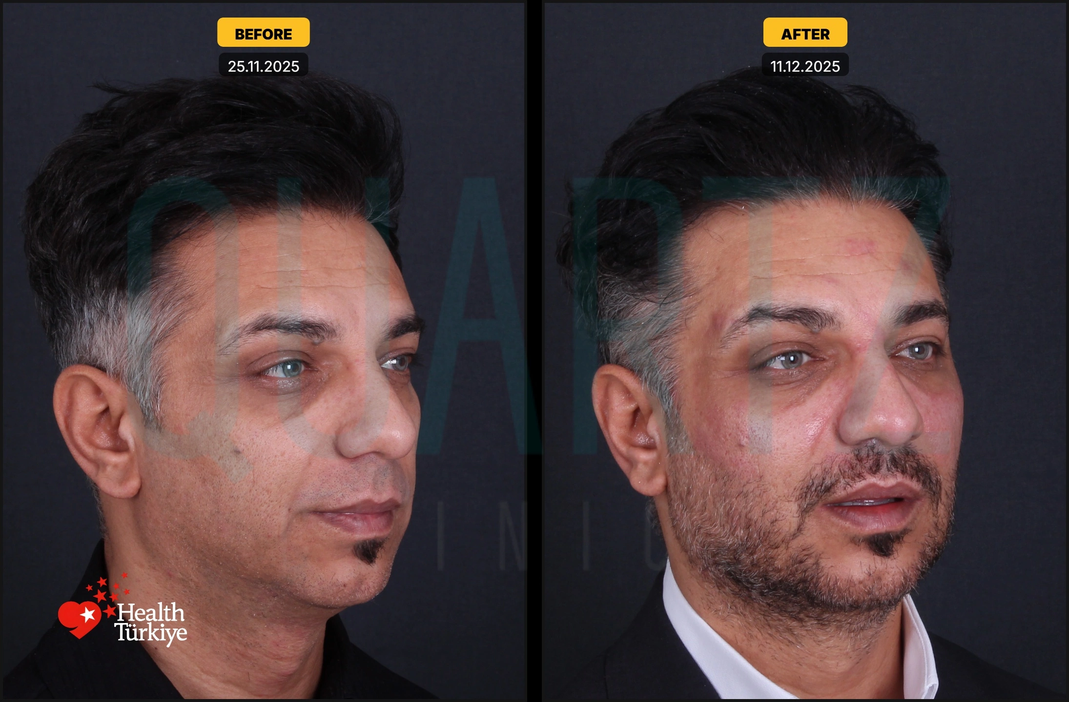 Before & After: Facial Fat Transfer Result 8
