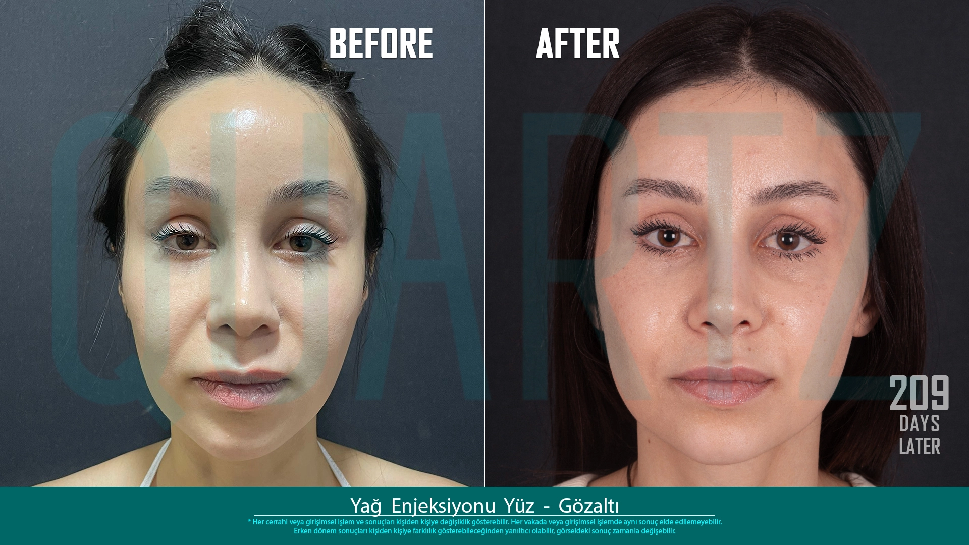 Before & After: Facial Fat Transfer Result 9