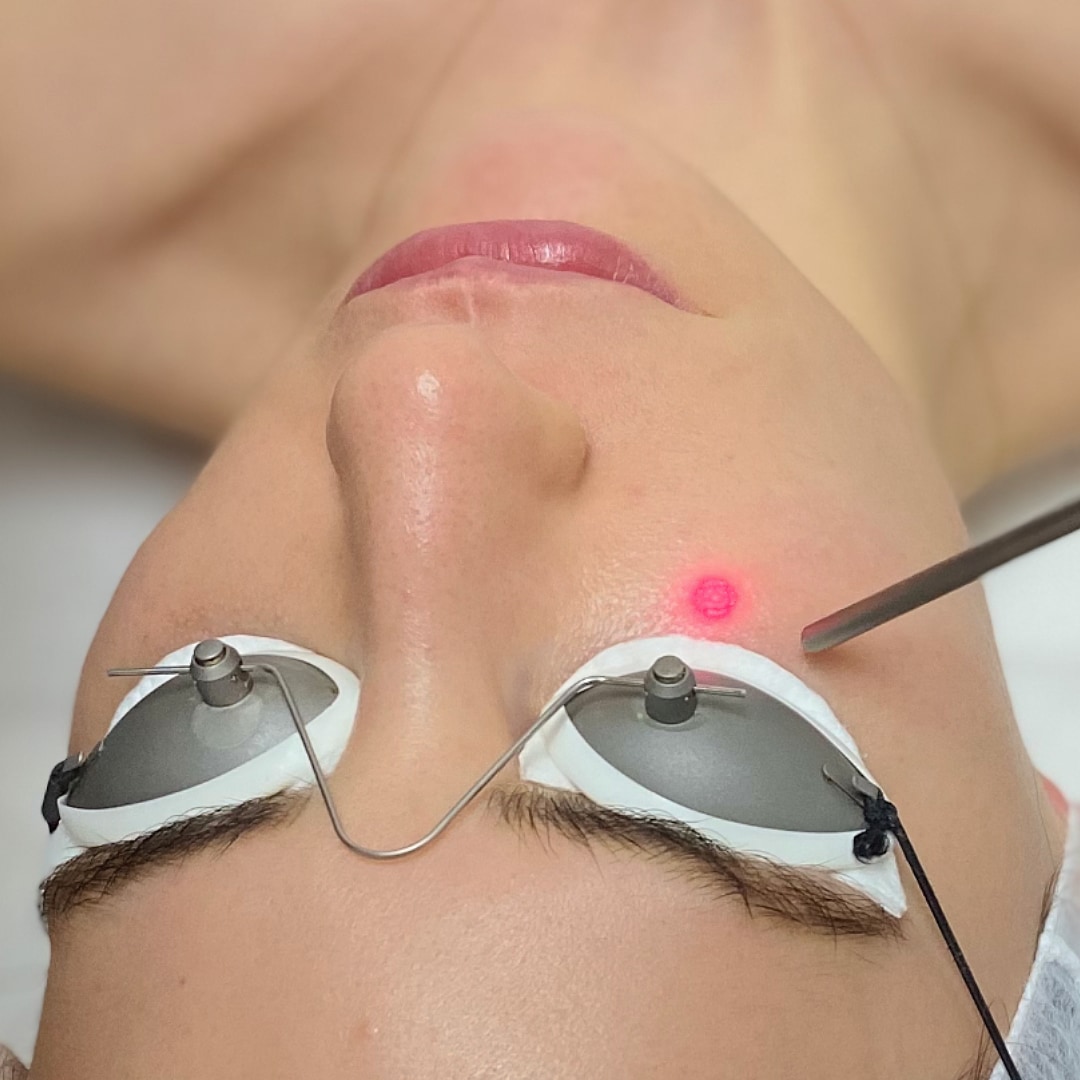 Q Switch lazer sonrası aydınlık yüz görünümü