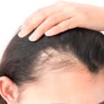 Kadınlarda Saç Ekimi