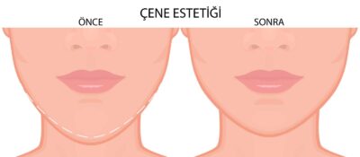 çene