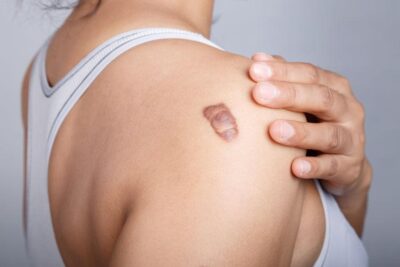 Keloid Tedavisi