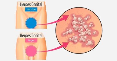 Nasıl testi yapılır herpes genital Herpes Simpleks