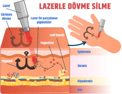  lazerle-dövme-sildirme