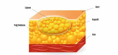 Yag Bezesi Nedir Lipoma Nasil Gecer Quartz Clinique