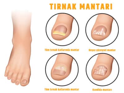 tırnak mantarı