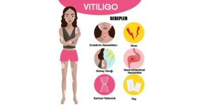 vitiligo neden olur