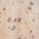 yaşlılık lekesi tedavisi