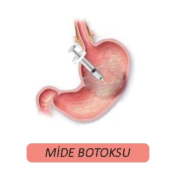 Mide botoksu