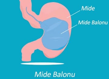 mide balonu