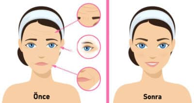Botox etkisi