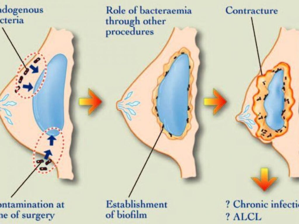 Capsular Contracture - Price - Istanbul, Turkey - Quartz Clinique
