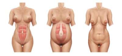 Diastasis Recti Treatment