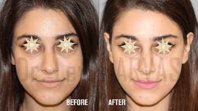 Radiesse Filler