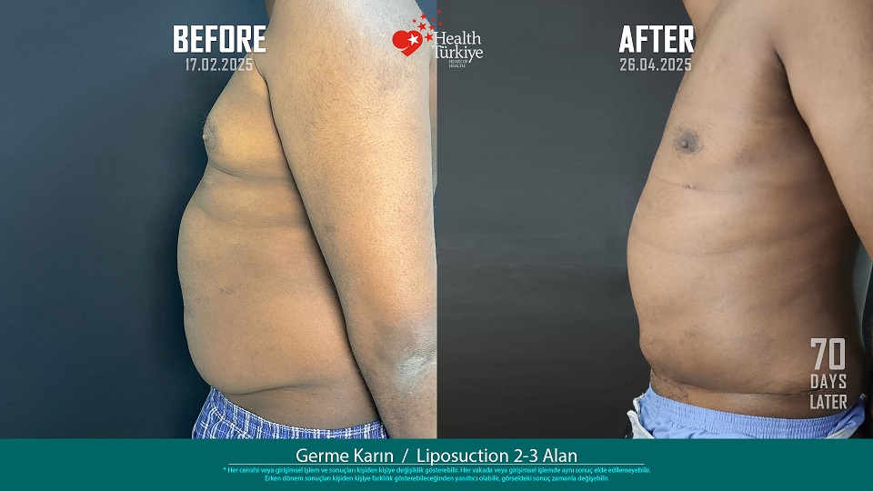 Germe Karın__Liposuction 2-3 Alan 00139EH Ahmed Jaama
