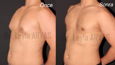 Gynecomastia Surgery