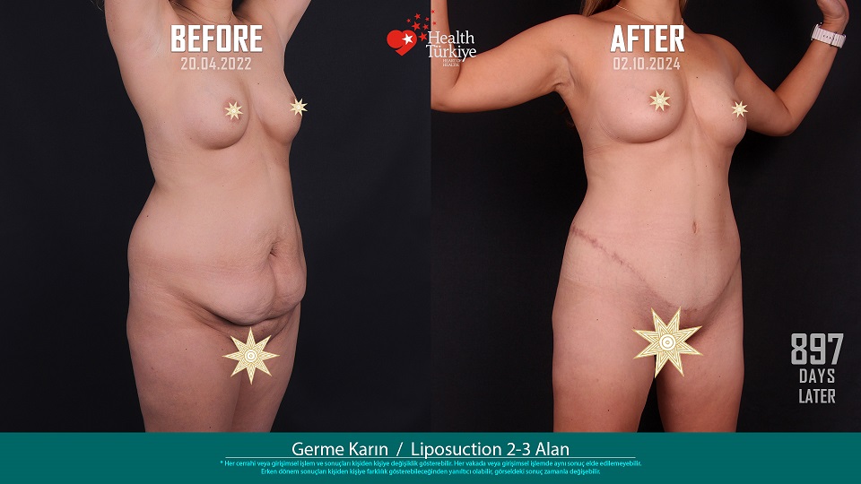 Karın Germe__Liposuction Karın Bel__Yağ Enjeksiyonu Popo 00130XH İlke Özbay