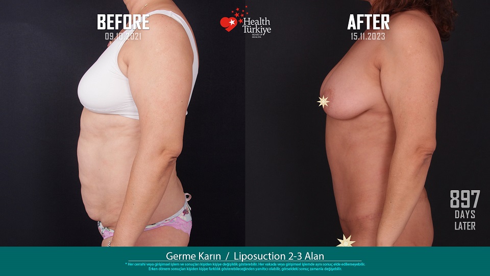 Karın Germe__Liposuction__Body Lift (768 Gün Sonra) 007GH Canan Göveren (Paylaşım İzni Alınmıştır)