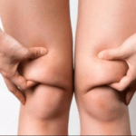 Knee Liposuction