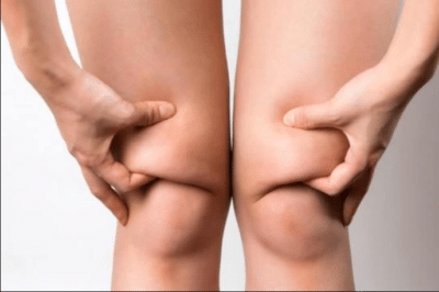 Knee Liposuction
