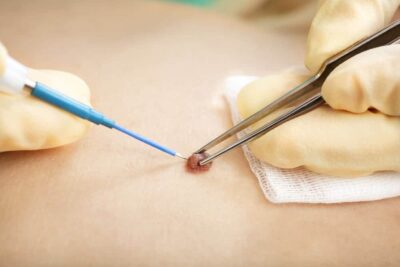 Electrosurgery For Skin Lesions