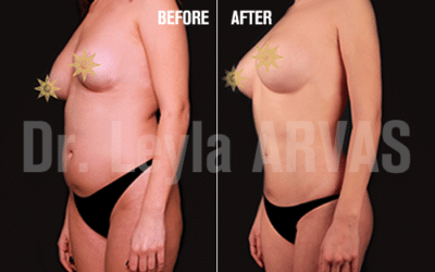 Abdominal And Stomach Liposuction