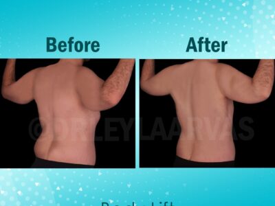 Body Shaping