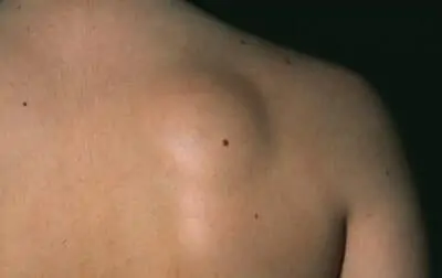 Sebaceous Cyst Treatment