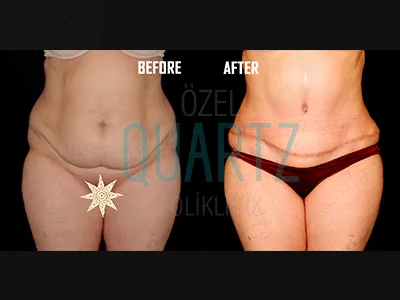 Tummy Tuck Revision