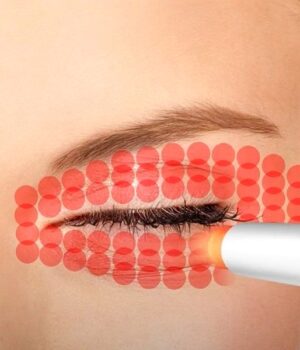 Fotona Smooth Eye