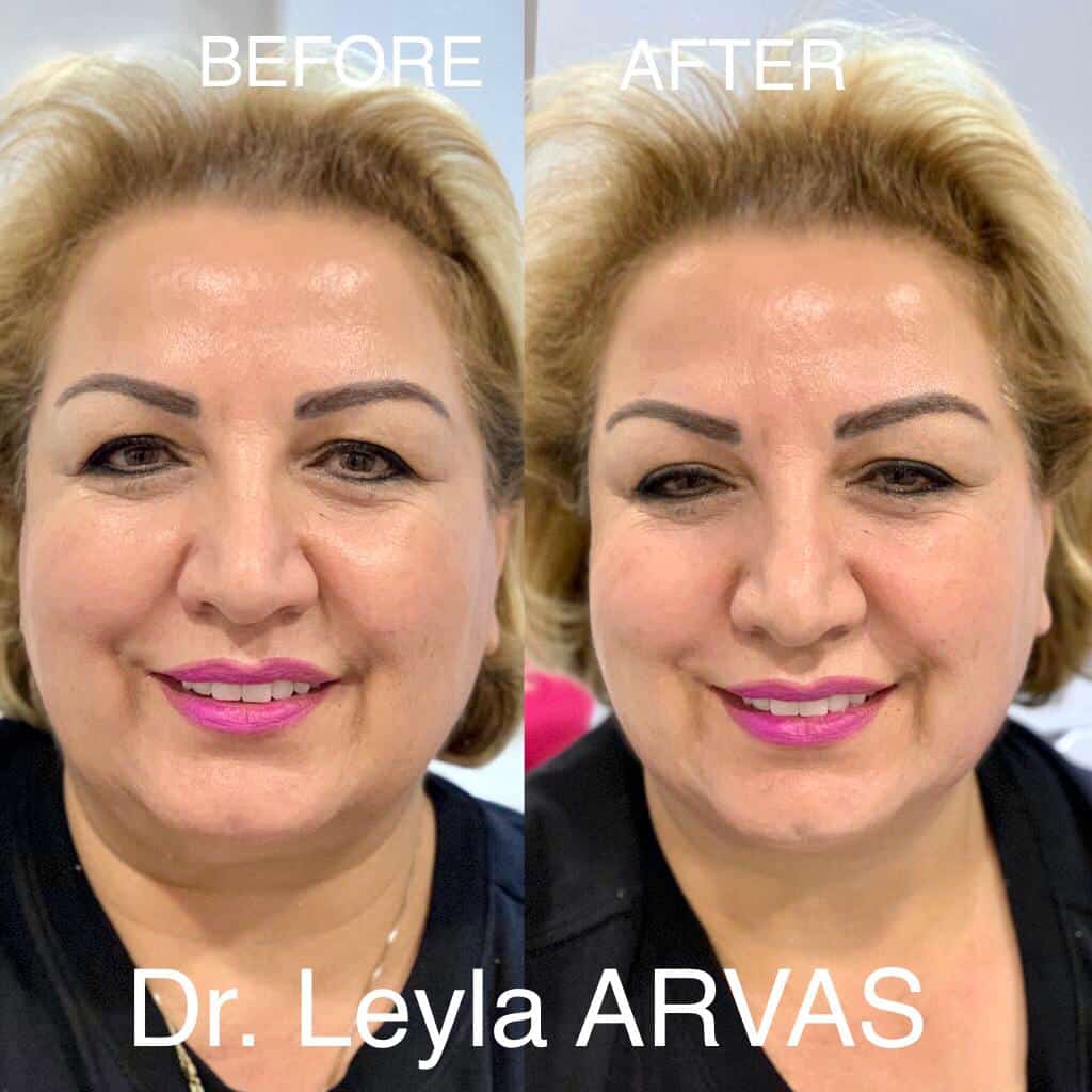 Ultherapy Ultherapy
