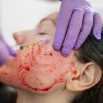 Vampire Facelift