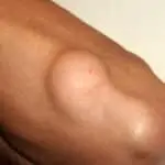 Lipoma Treatment