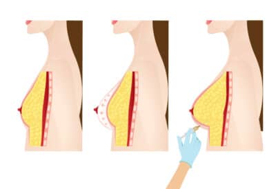 Lipofilling Mammaire 
