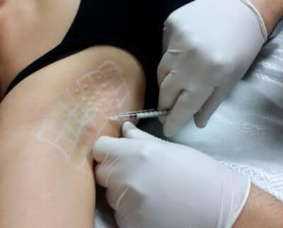 Botox Sweating Treatment