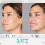 Jawline Filler