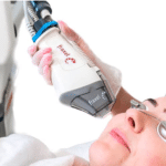 Fraxel-Laser-Behandlung